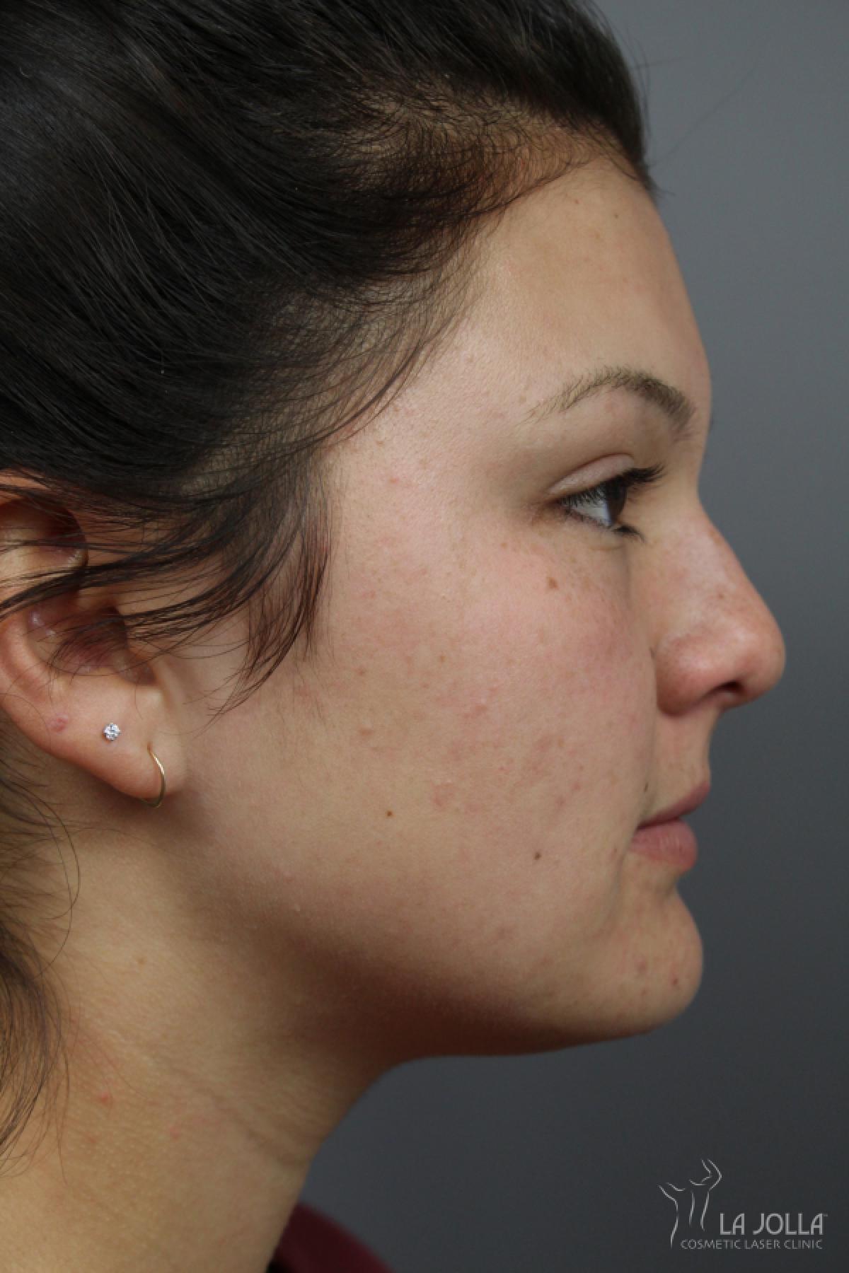 Non-Surgical Nose Job: Patient 5 - Before 