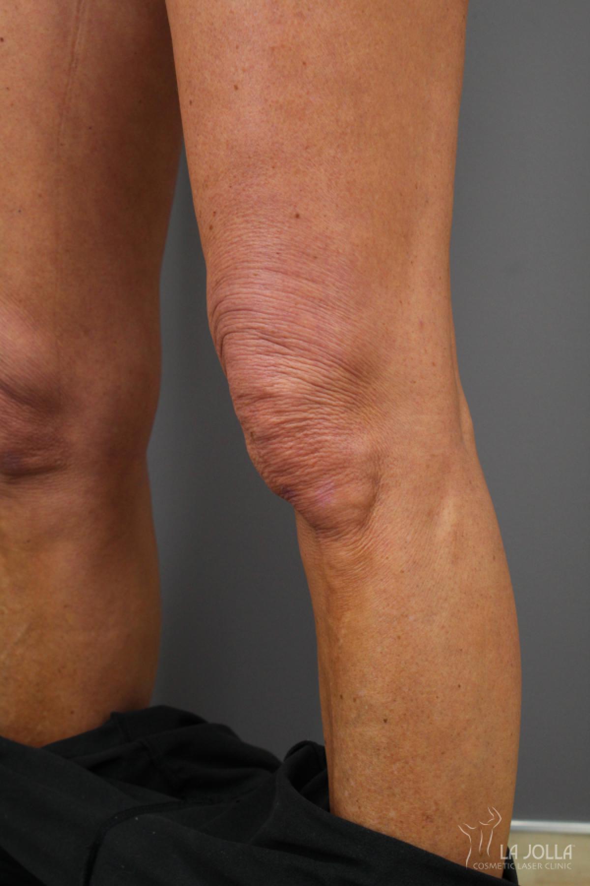 StarWalker® Laser: Patient 7 - After  