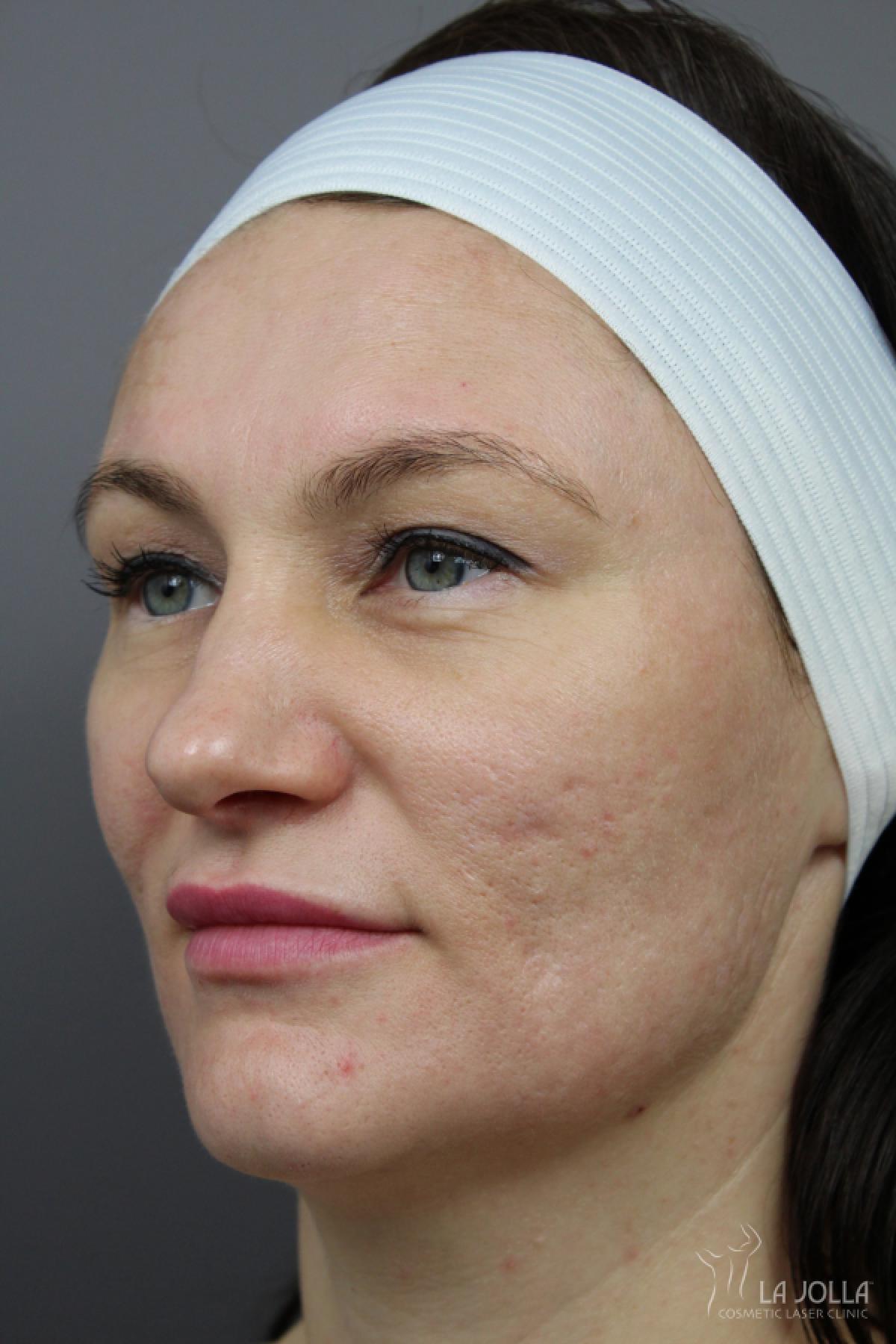 Acne Scars: Patient 5 - After 1