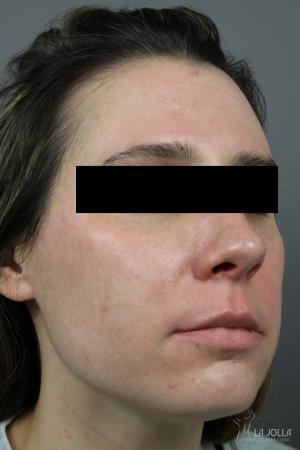 Chemical Peel: Patient 7 - After 2