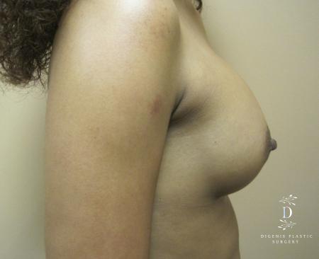 Breast Augmentation: Patient 14 - After 2