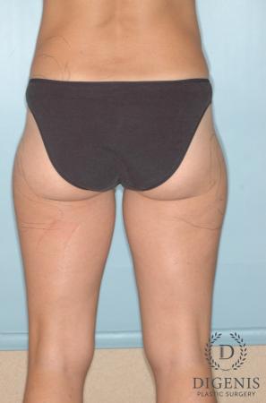 Liposuction: Patient 6 - Before 2