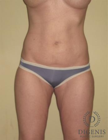 Liposuction: Patient 1 - After  