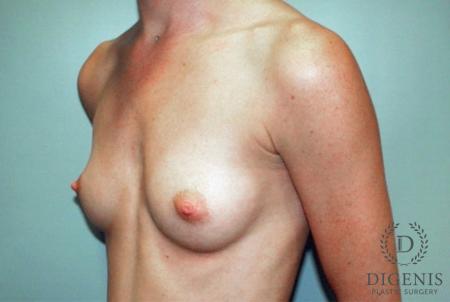 Breast Augmentation: Patient 1 - Before 1