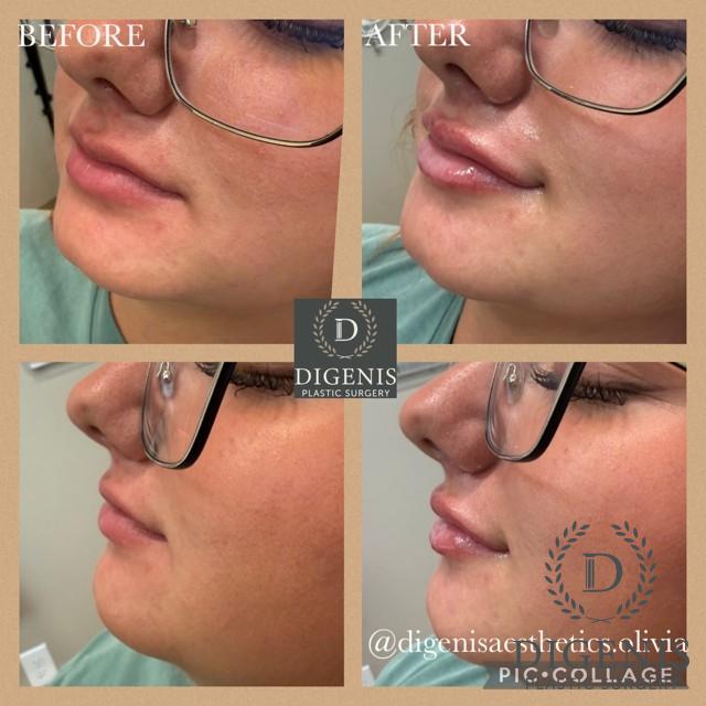 Injectables: Patient 8 - Before and After  