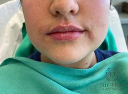 Injectables: Patient 1 - After  