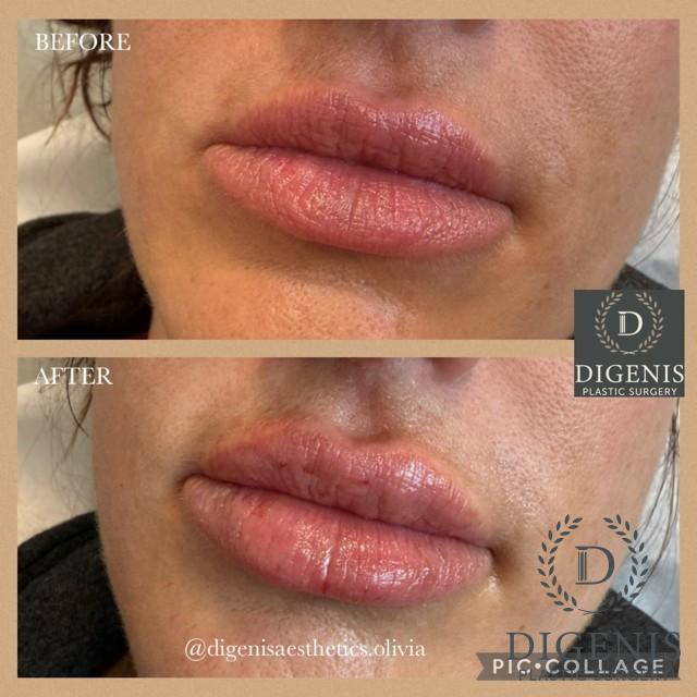 Injectables: Patient 2 - Before and After  