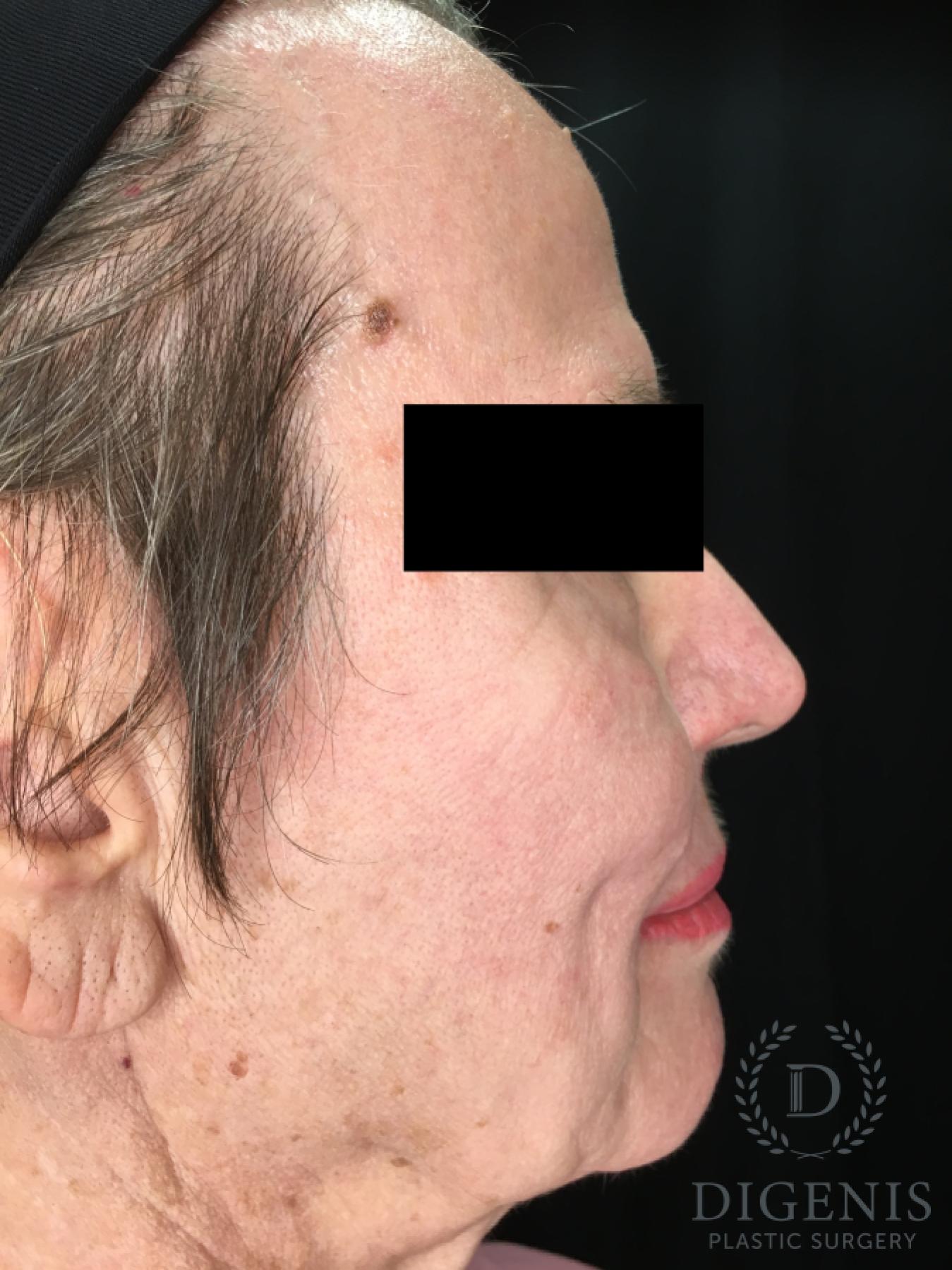 Facelift: Patient 31 - Before and After 6