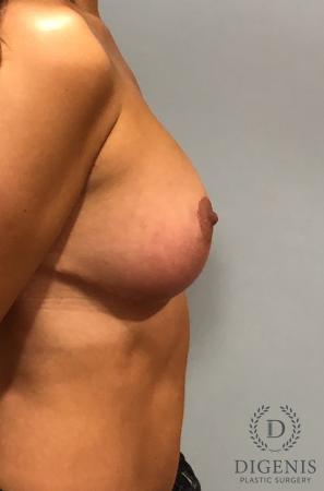 Breast Augmentation: Patient 10 - After 3