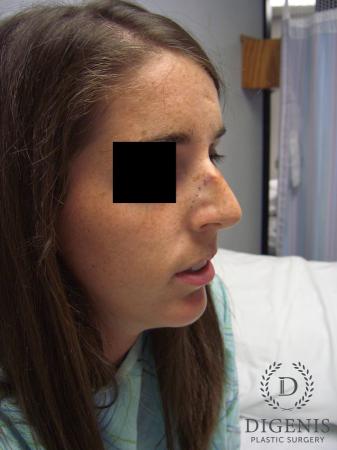 Rhinoplasty: Patient 6 - Before 2