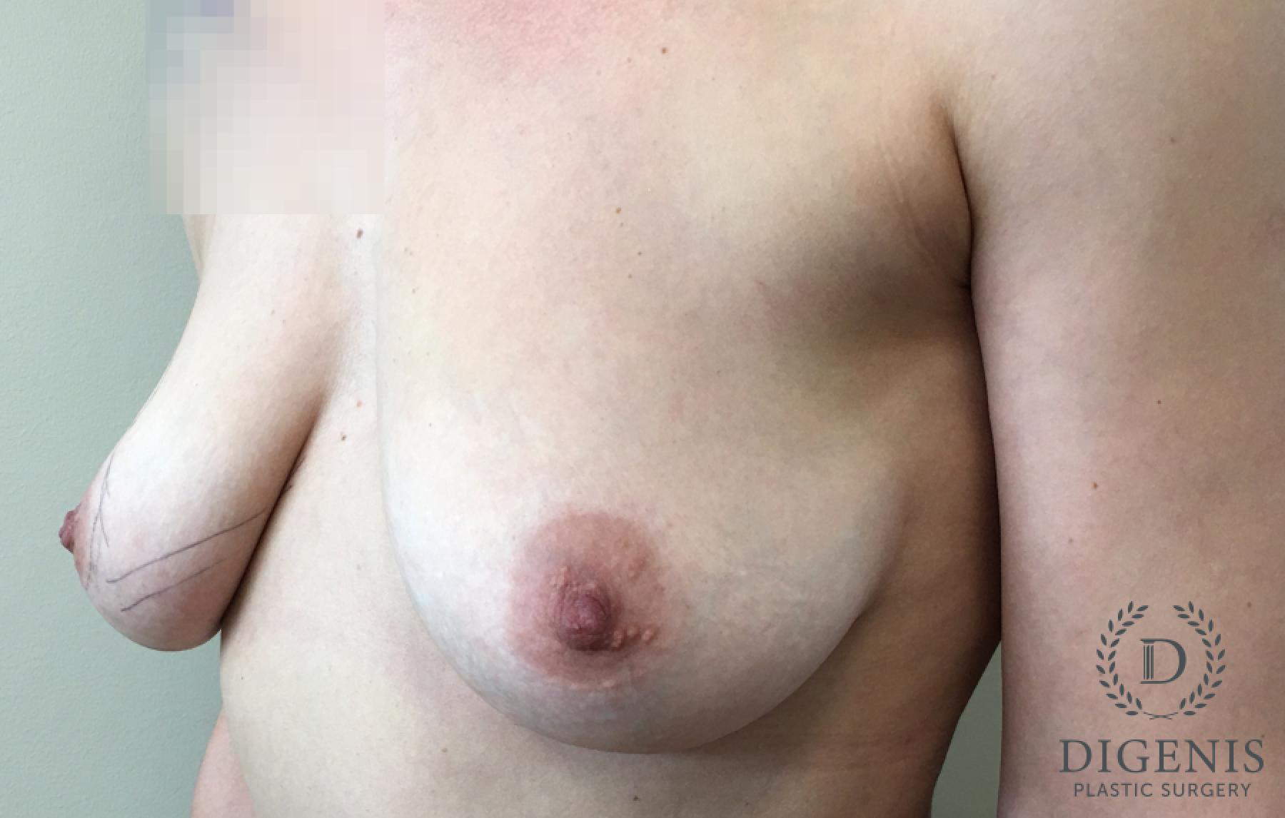 Breast Implant Exchange: Patient 7 - Before and After 5