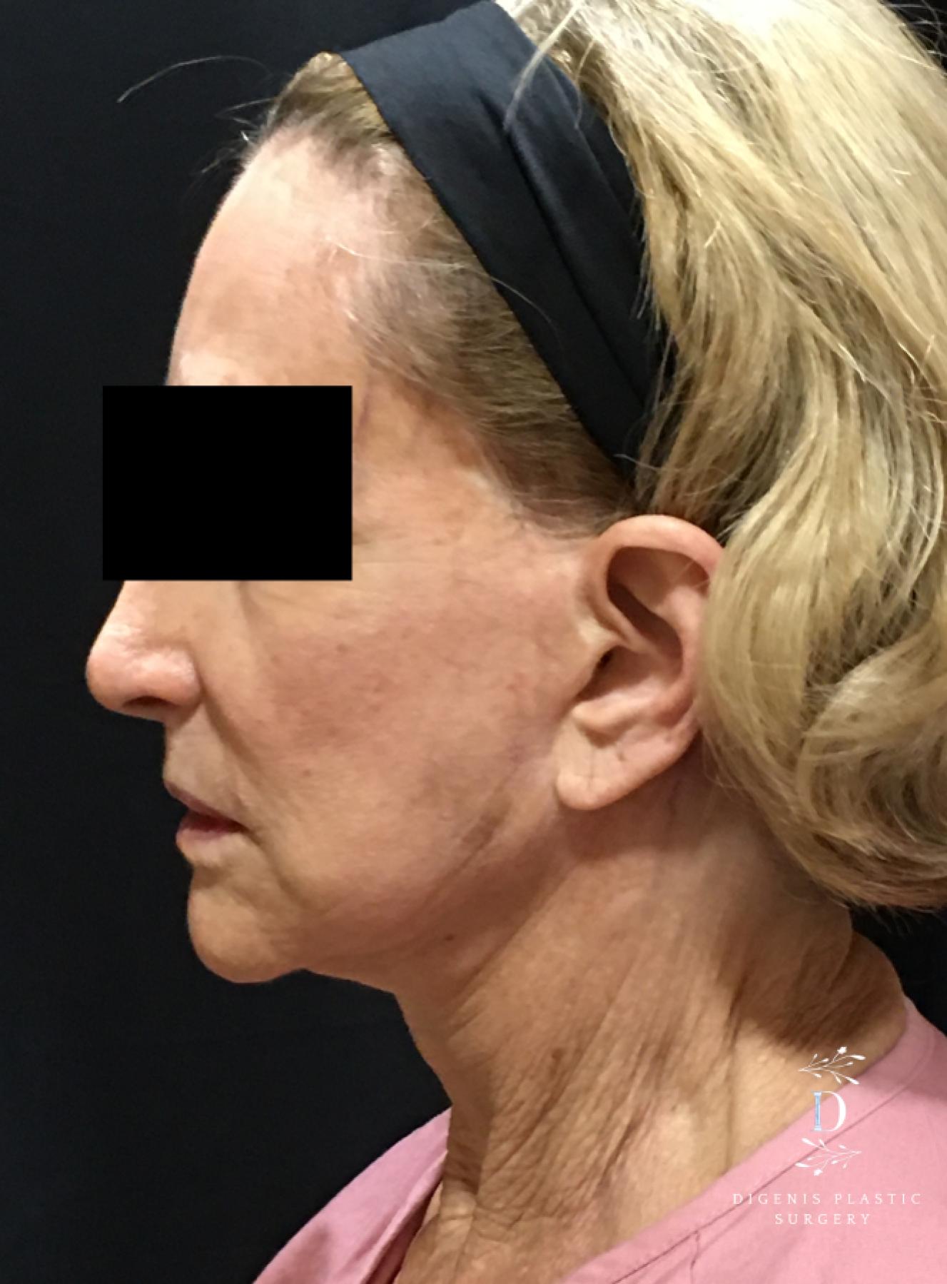 Facelift: Patient 23 - Before and After 5