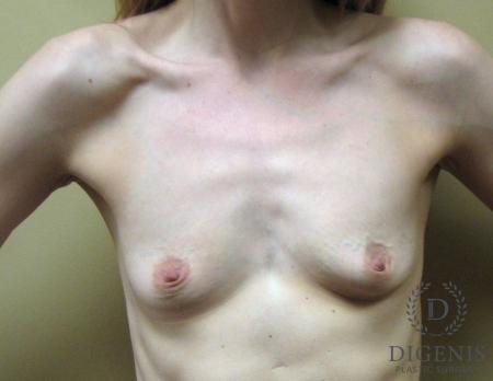 Breast Augmentation: Patient 2 - Before 1
