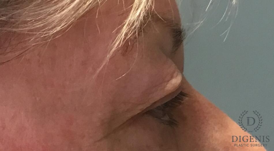 Eyelid Surgery: Patient 77 - Before 3