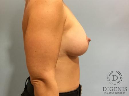 Breast Augmentation: Patient 12 - After 3