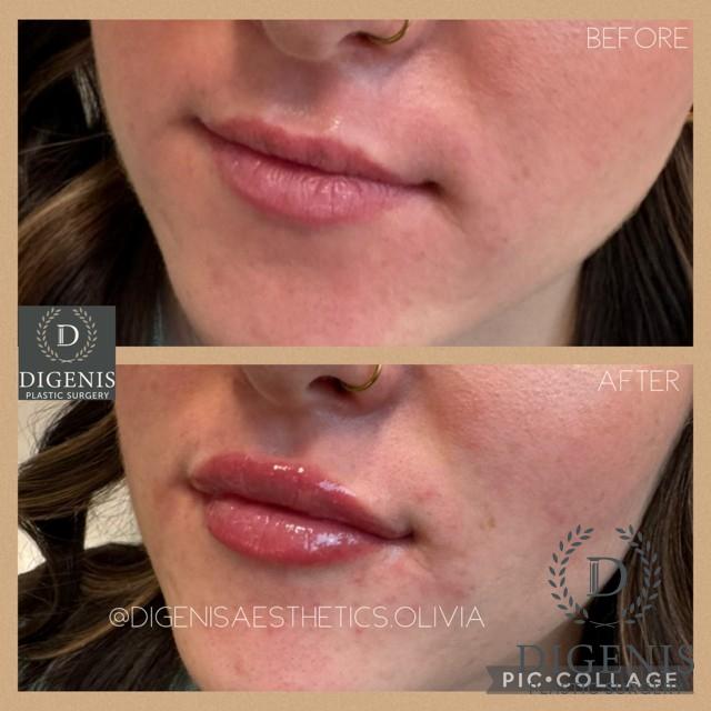 Injectables: Patient 5 - Before and After  