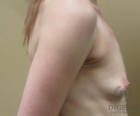 Breast Augmentation: Patient 2 - Before 3