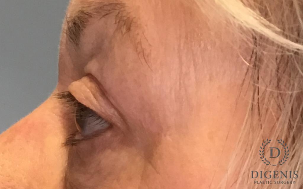 Eyelid Surgery: Patient 77 - After 5