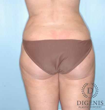 Liposuction: Patient 4 - After 2