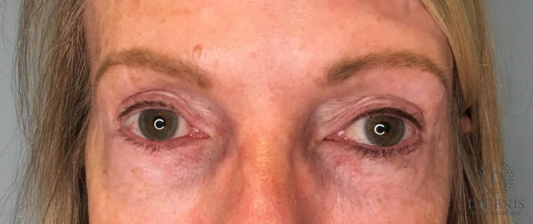 Blepharoplasty: Patient 16 - After 