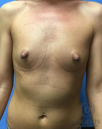 Breast Augmentation: Patient 9 - Before 1