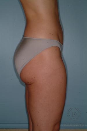 Liposuction: Patient 3 - After 3