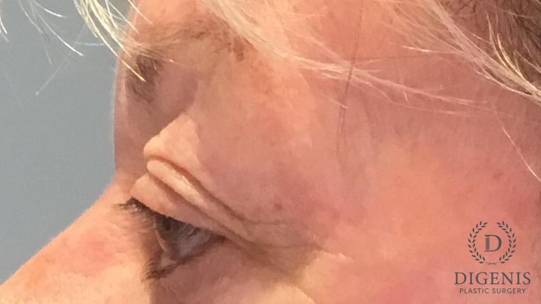Eyelid Surgery: Patient 77 - Before and After 5