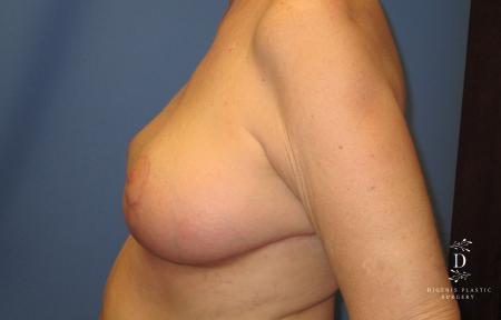 Breast Lift: Patient 6 - After 5