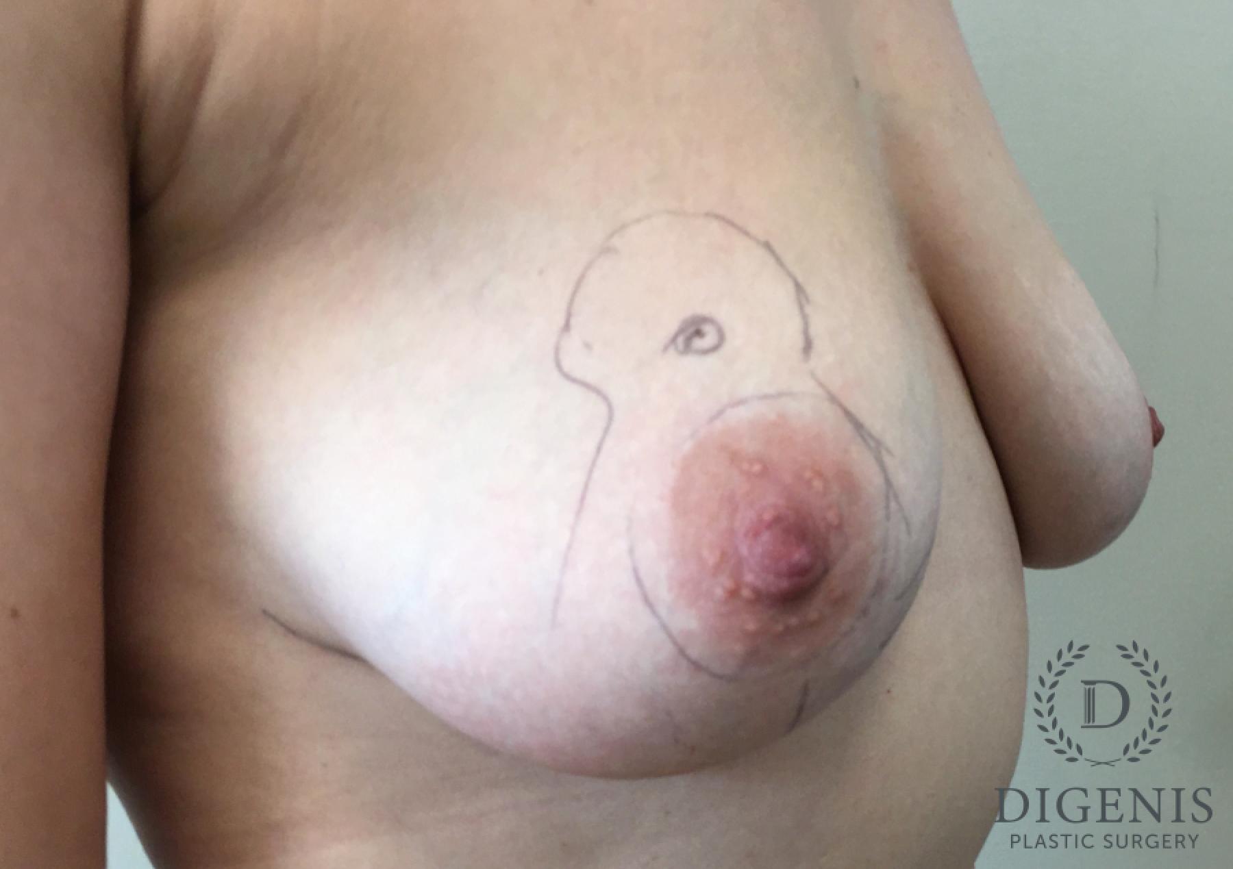 Breast Implant Exchange: Patient 7 - Before 2