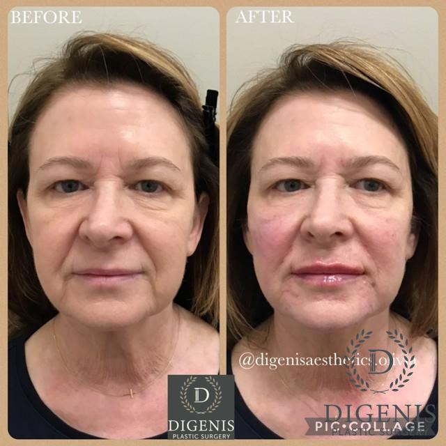 Injectables: Patient 3 - Before and After  