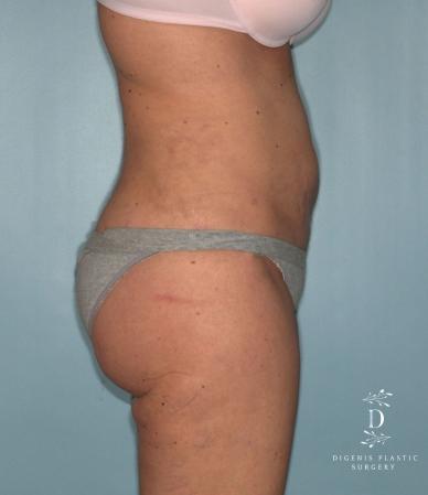 Liposuction: Patient 7 - After 2