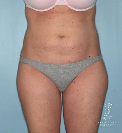 Liposuction: Patient 7 - After  