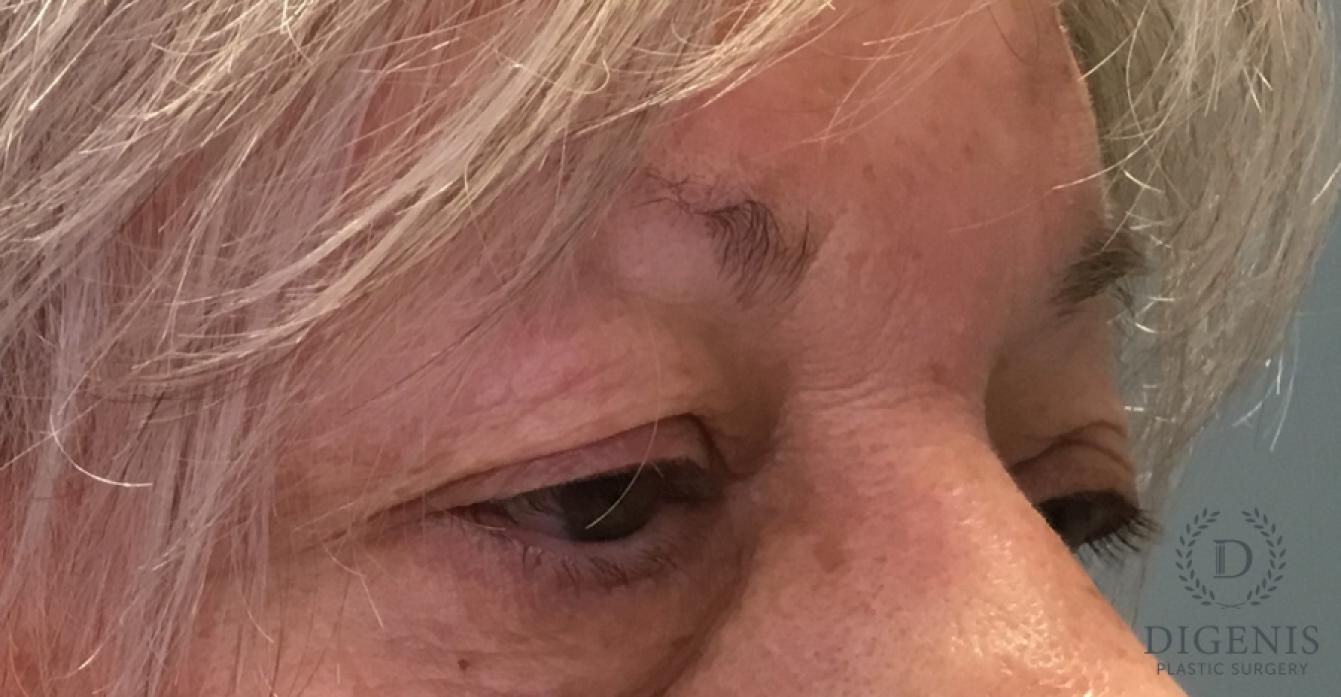 Eyelid Surgery: Patient 77 - Before 2