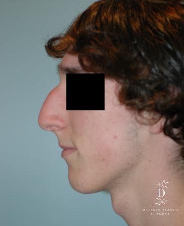 Rhinoplasty: Patient 9 - Before and After 5