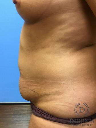 Abdominoplasty: Patient 1 - Before and After 5