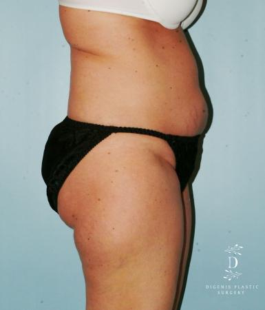 Liposuction: Patient 7 - Before 2
