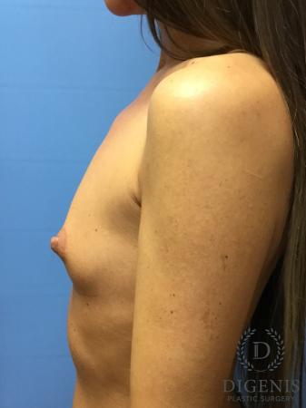 Breast Augmentation: Patient 9 - Before and After 5