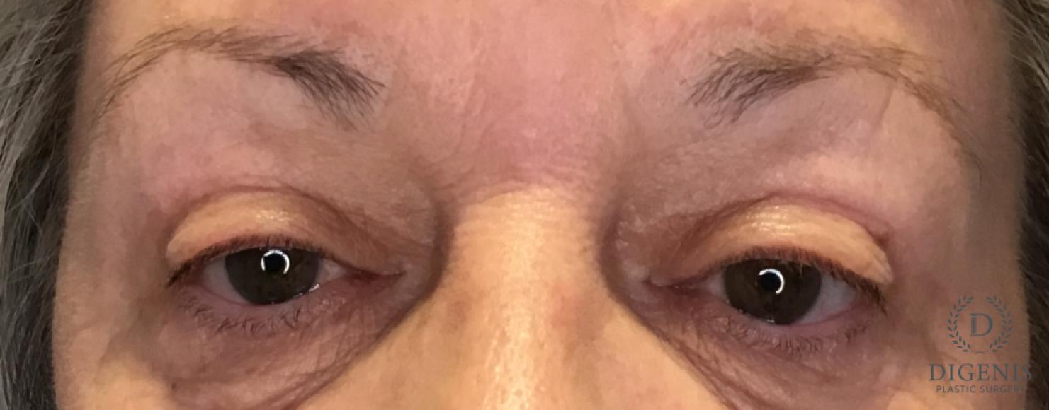 Eyelid Surgery: Patient 77 - After 1