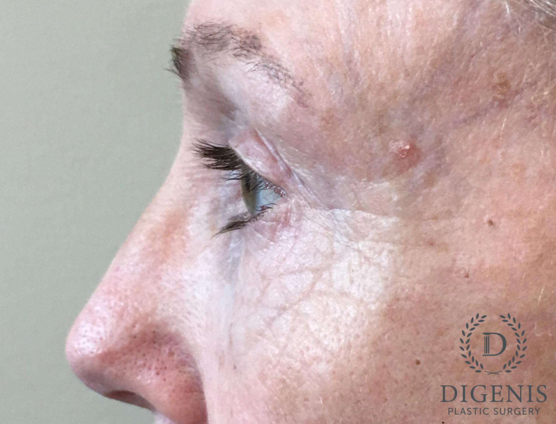 Blepharoplasty: Patient 13 - Before and After 5