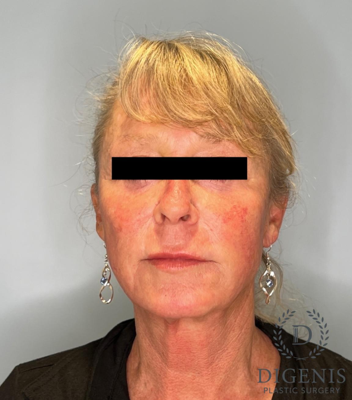 Facelift: Patient 1 - After  