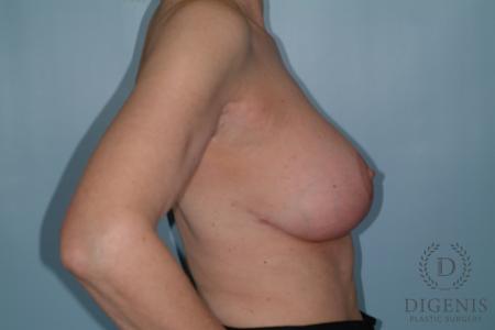 Breast Lift With Implants: Patient 6 - After 3