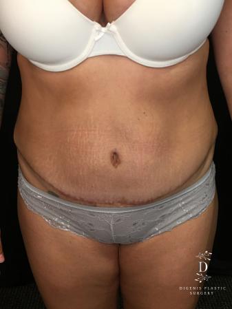 Abdominoplasty: Patient 6 - After  