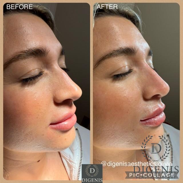 Injectables: Patient 9 - Before and After  
