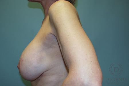 Breast Lift With Implants: Patient 6 - Before and After 5