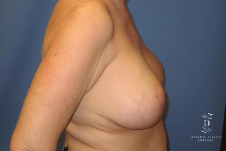 Breast Lift: Patient 6 - After 3