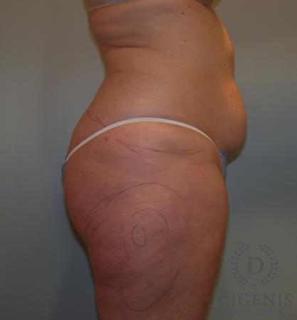 Liposuction: Patient 4 - Before 3