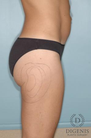 Liposuction: Patient 6 - Before 3