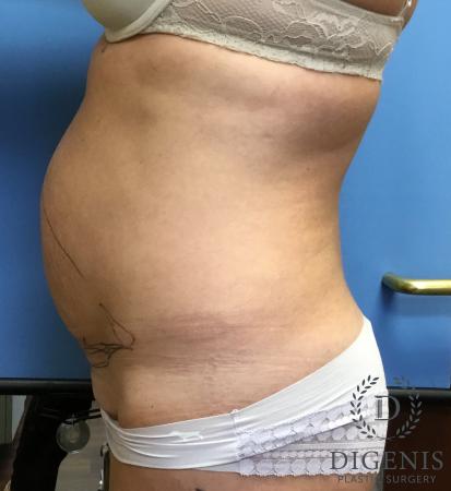 Abdominoplasty: Patient 2 - Before and After 4