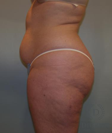 Liposuction: Patient 4 - Before and After 4