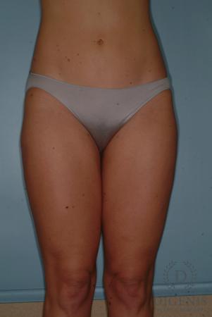Liposuction: Patient 3 - After  